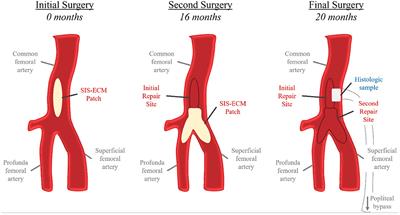 Extracellular Matrix Patches for Endarterectomy Repair